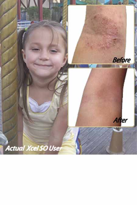 child with eczema